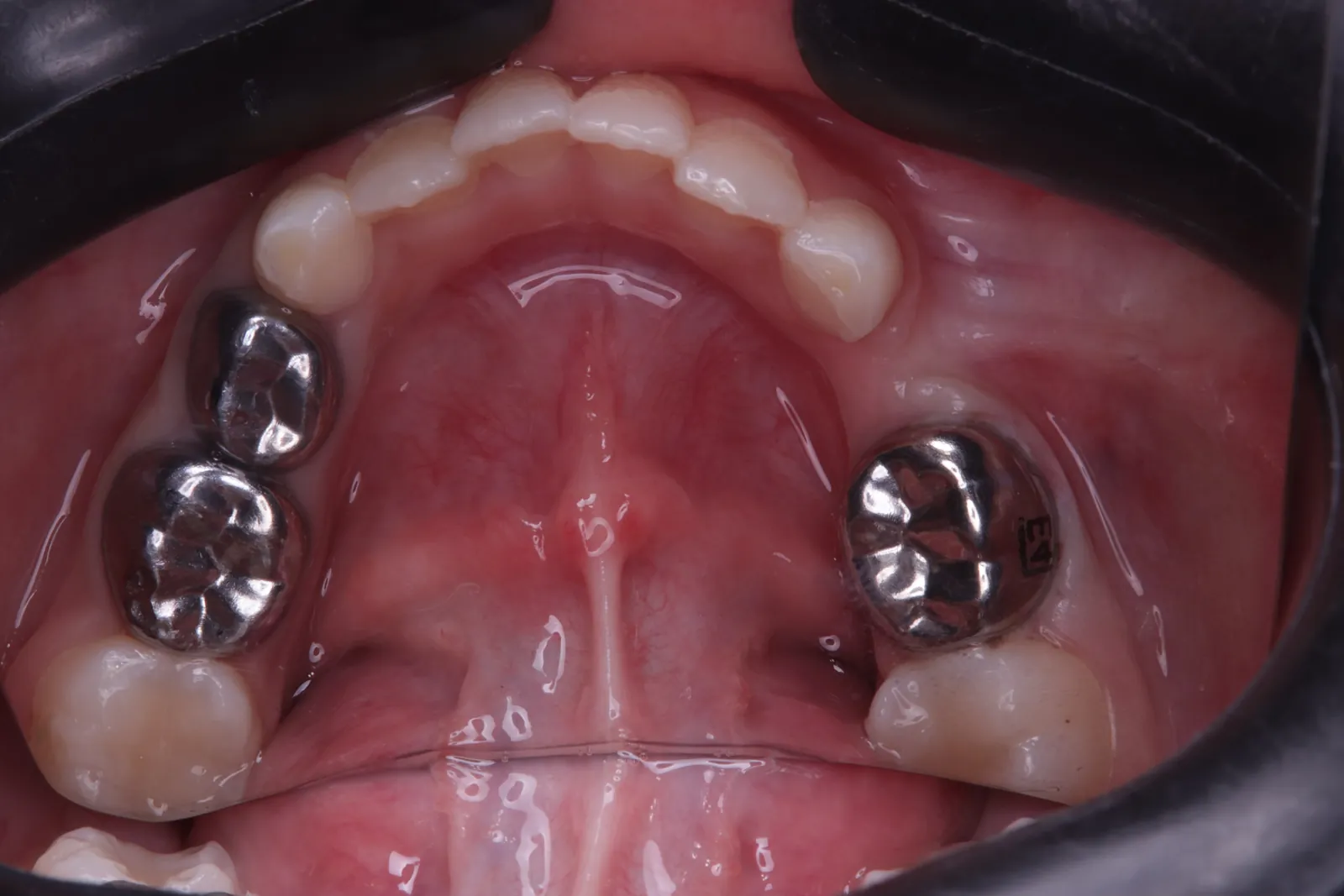 Crowns on baby molars