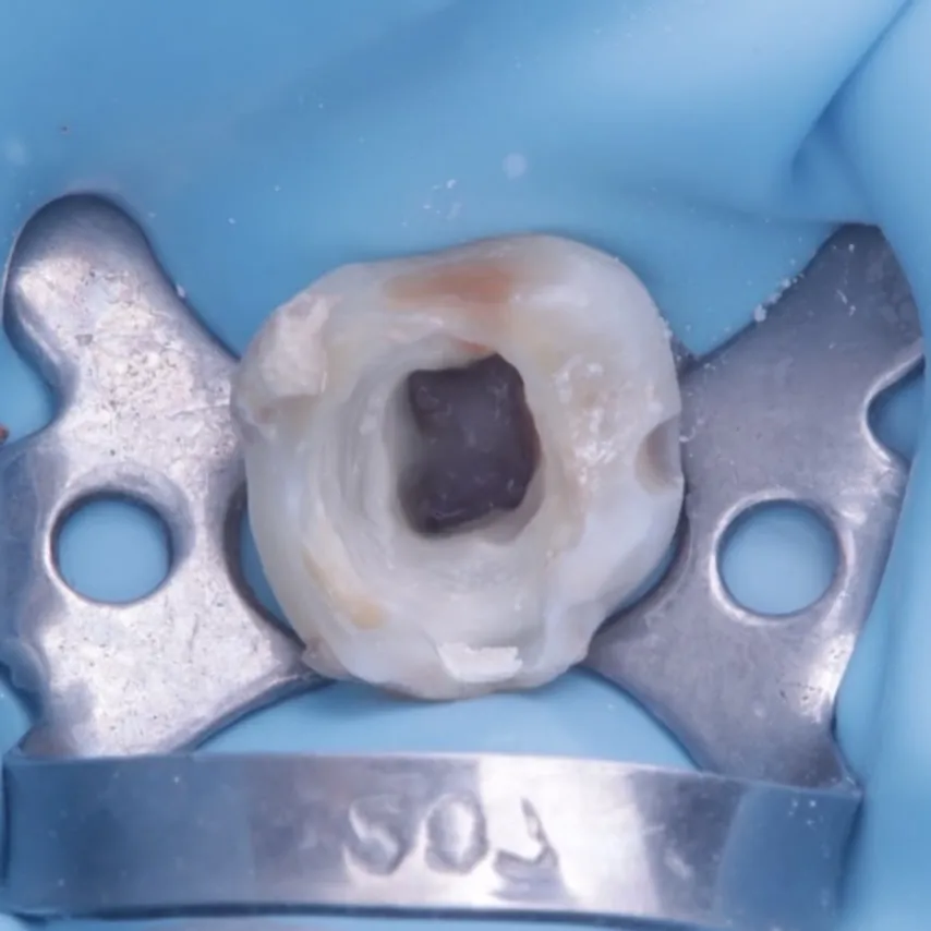 Nerve treatment of a baby molar, isolated with a rubber dam