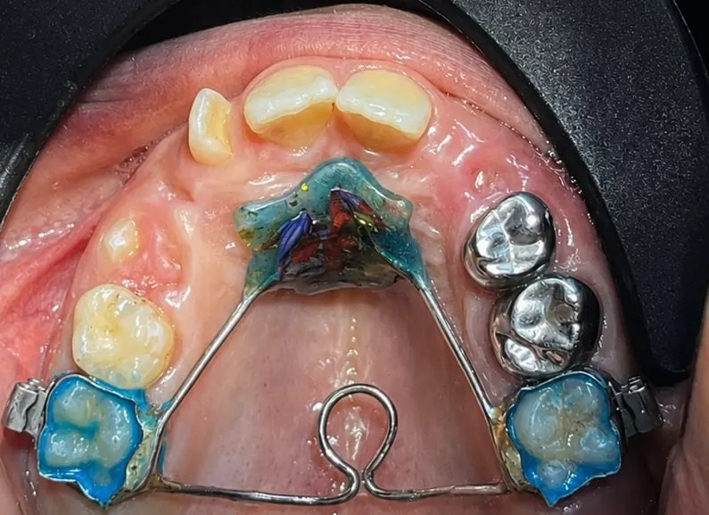 A fixed appliance in a child’s mouth